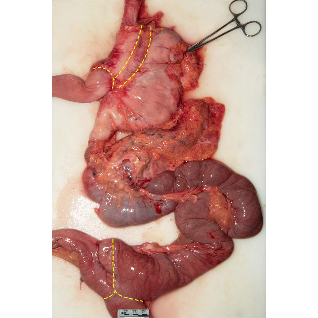 detroitsdocket's tweet photo. 3. The food will move directly from the stomach pouch to the small intestines bypassing the stomach and a portion of the small intestines. This will reduce the amount of food absorbed by the digestive system. https://t.co/NhWJkmO5eP