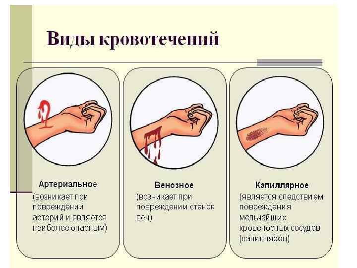 Насколько опасно делать. Типы кровотечений в зависимости от типа поврежденного сосуда. Виды кровотечений по виду поврежденного сосуда. Типы крови венозная и артериальная капиллярная.