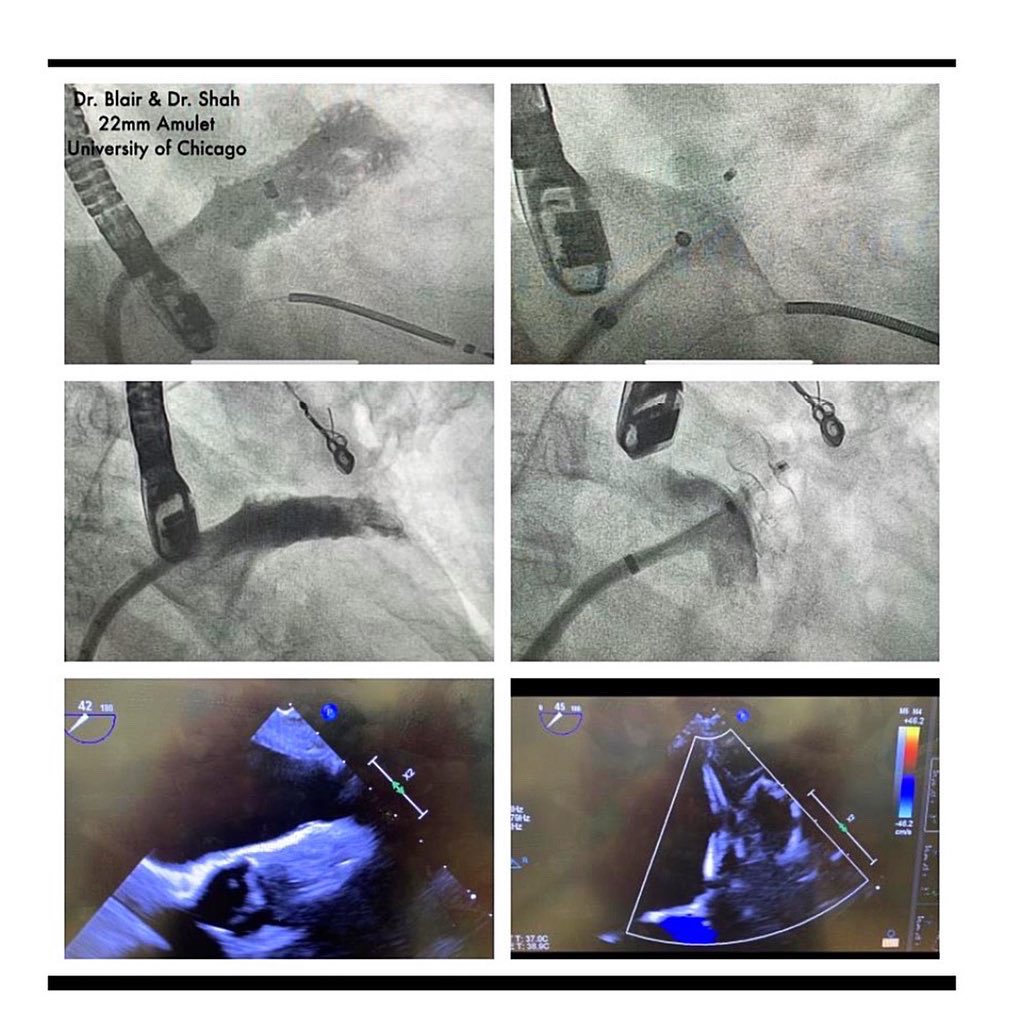 UChicagoHVC (@uchicagohvc) on Twitter photo <a href="/UChicago/">The University of Chicago</a> has completed its first procedures using <a href="/Abbott/">Bruce Abbott</a> #Amplatzer #Amulet LAA Occluder. A non-surgical therapy uses dual-seal technology to completely and immediately seal the LAA, reducing the risk of stroke in patients with #afib and eliminating the need for blood thinners <a href="/UChicago/">The University of Chicago</a> has completed its first procedures using <a href="/Abbott/">Bruce Abbott</a> #Amplatzer #Amulet LAA Occluder. A non-surgical therapy uses dual-seal technology to completely and immediately seal the LAA, reducing the risk of stroke in patients with #afib and eliminating the need for blood thinners
