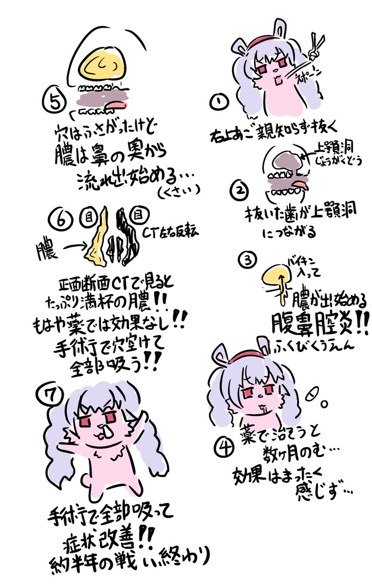 今回の劇場版「親知らずを抜いただけなのに…」
簡単に流れを描きました
親知らずを抜くだけで副鼻腔炎になり手術まで行きつく事があるんです!
個人的には上顎洞に繋がってしまった時に即大きな病院に行くべきだったなと感じました 