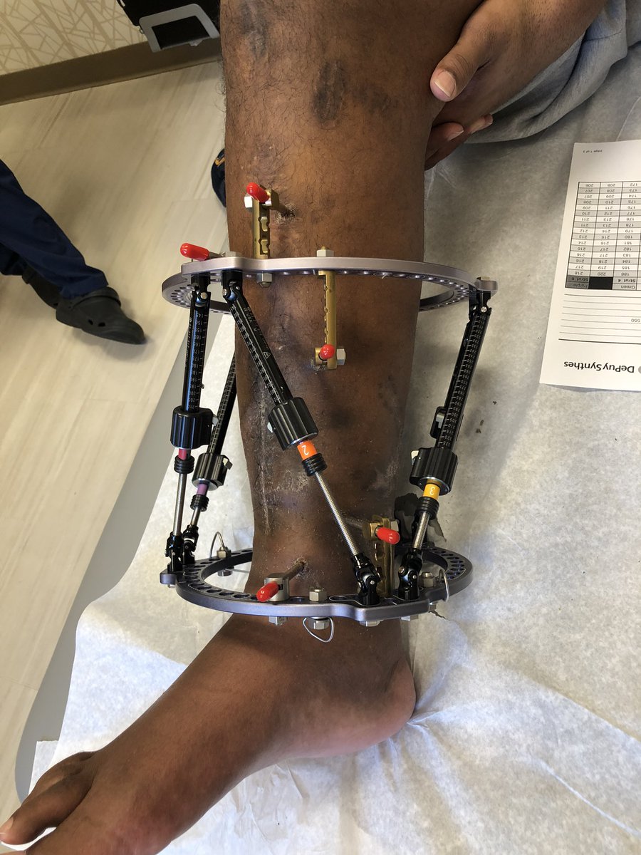 The new MaxFrame hardware is amazing and really rounds out the set. While the swivel technology is useful, now we get that 90 deg fixed angle fixation we were missing.