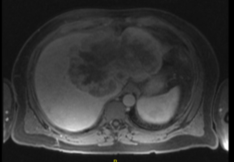 (1/4)As Cholangiocarcinoma awareness month draws to close wanted to point out aggressive multi-disciplinary treatment offers opportunity for success w unresectable CCA.  18 cm tumor w outflow obstruction resulting in aborted trisegmentectomy due to unstable BP and liver bleeding.