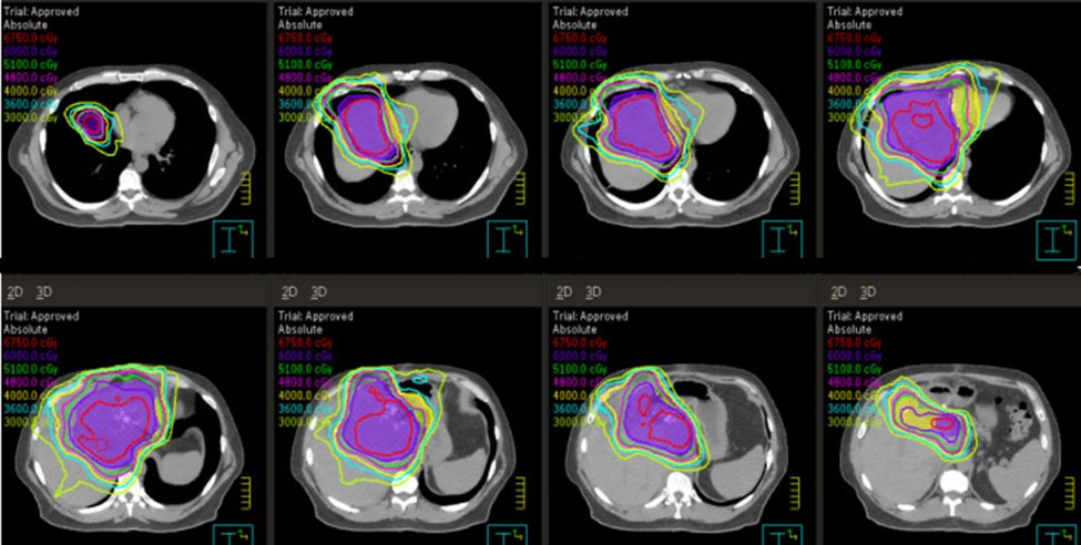 (2/4)Treated w 4 cycles gem-cis, followed by y90 and consolidative high dose hypofractionated XRT (a/w improved survival compared to conventional XRT by <a href="/haydencrane5/">Christopher H. Crane</a> and Randa Tao).  Lower dose PTV’s on edge to maintain normal tissue. 60-67.5 Gy/15 fx to center. higher better.