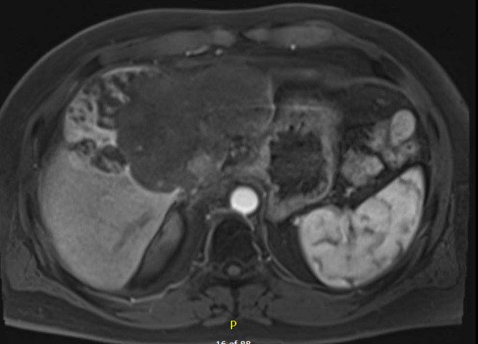 (3/4)Now over 2 years from treatment with no radiographic evidence of residual disease.  Intact liver function and excellent performance status.  Fortunate to work with excellent colleagues in medical oncology, interventional radiology, and hepatobiliary surgery <a href="/ClevelandClinic/">Cleveland Clinic</a>.
