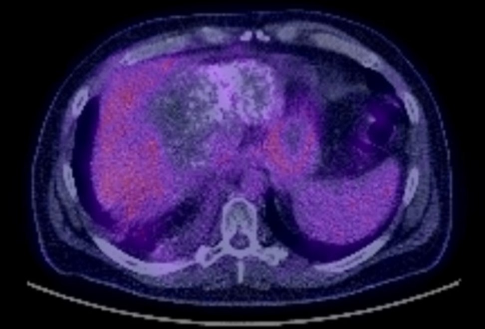 (4/4) PET scan negative for residual disease too.  Will follow.  Integration of multidisciplinary care and access to new technology can open doors.  Grateful to the brave patients who have walked this path, amazed to see what they can accomplish in treatment and in life.