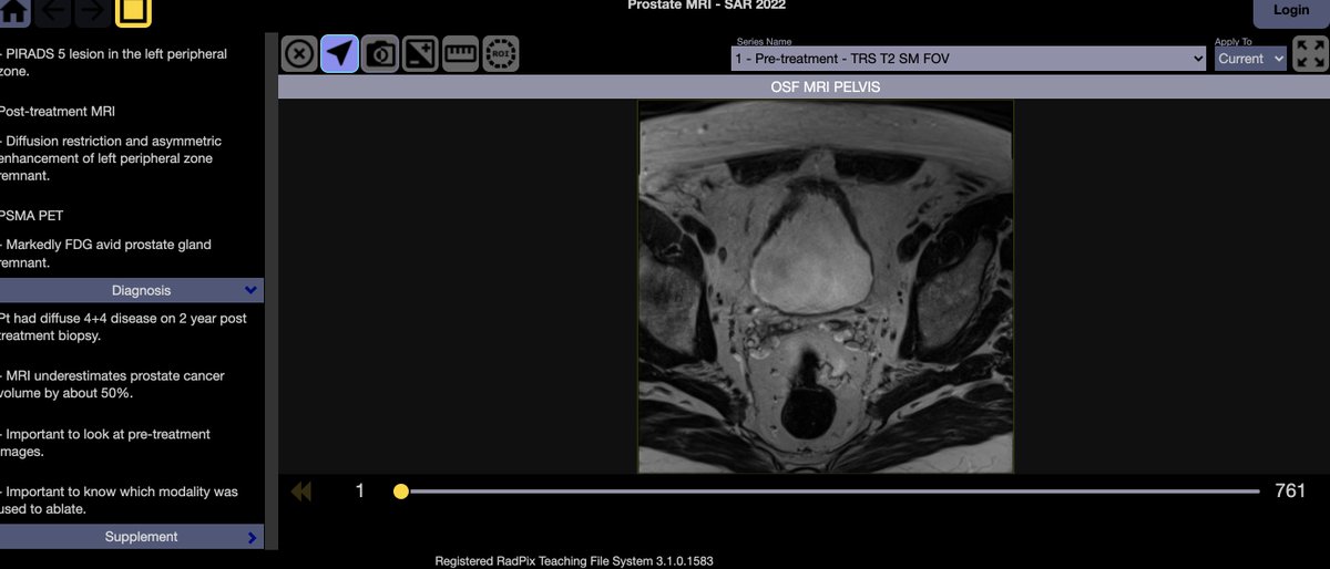 Sandeep Arora (@letddiceflyhigh) on Twitter photo Last chance - we have made one of our cases public to whet your appetite. Register for the Prostate HOC #SAR2022 @SocAbdRadiology <a href="/SAR_ProstateDFP/">SAR Prostate DFP</a>. All 55 cases are available for remote access-for 3 months. It will be awesome! Next year we will have 100.
radpix.abdominalradiology.org/rtfs/public-20… Last chance - we have made one of our cases public to whet your appetite. Register for the Prostate HOC #SAR2022 @SocAbdRadiology <a href="/SAR_ProstateDFP/">SAR Prostate DFP</a>. All 55 cases are available for remote access-for 3 months. It will be awesome! Next year we will have 100.
radpix.abdominalradiology.org/rtfs/public-20…