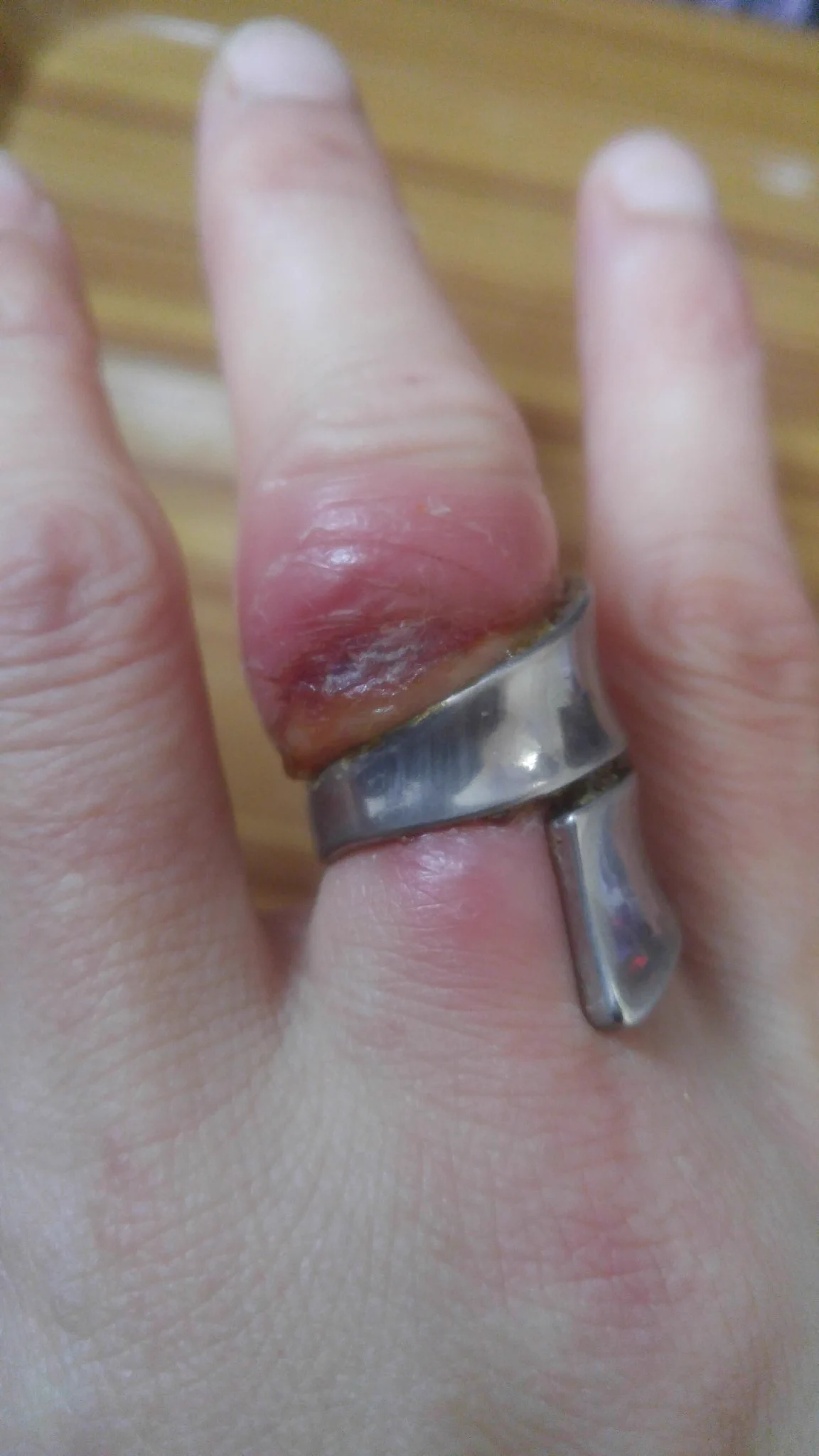 @tarotarogorira FF外から失礼します。
閲覧注意⚠
妊娠でゎないですが😓
こんなんなって、病院で早くしなぃと壊死して切断しなきゃならなくなります❗
って言われました。
翌日、外科にて処置してもらぃ。
今ゎ完全でゎなぃケド。
火傷の後みたぃな感じです😓 