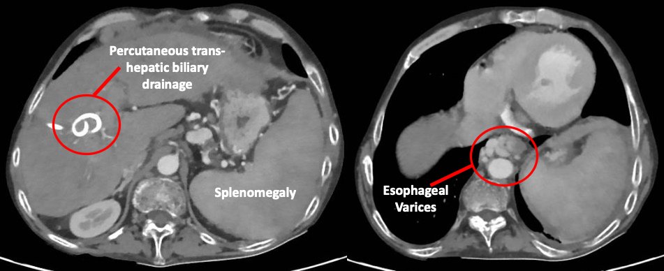 #AKIConsultseries 40 y ♂️ with advanced liver Cirrhosis (Secondary sclerosing cholangitis) 🏥 for encephalopathy. Now with rising Cr. Tx w IV albumin for the last 48 hrs with no improvement. 

I like to review recent imaging studies to confirm signs of advanced cirrhosis👇 

1/9