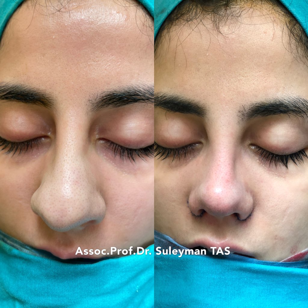 drsuleymantas's tweet photo. Almost all problems a nose can have are here🤗 :Crooked C shaped nose with breathing issue, asymmetrical nostrils, bulbous tip, thick skin, the need for downsizing, the need for redraping, etc.
But no problem at all 😎✨ #nosemaster #drsuleymantas #rhinoplasty #nosejob https://t.co/2bIutEskIj