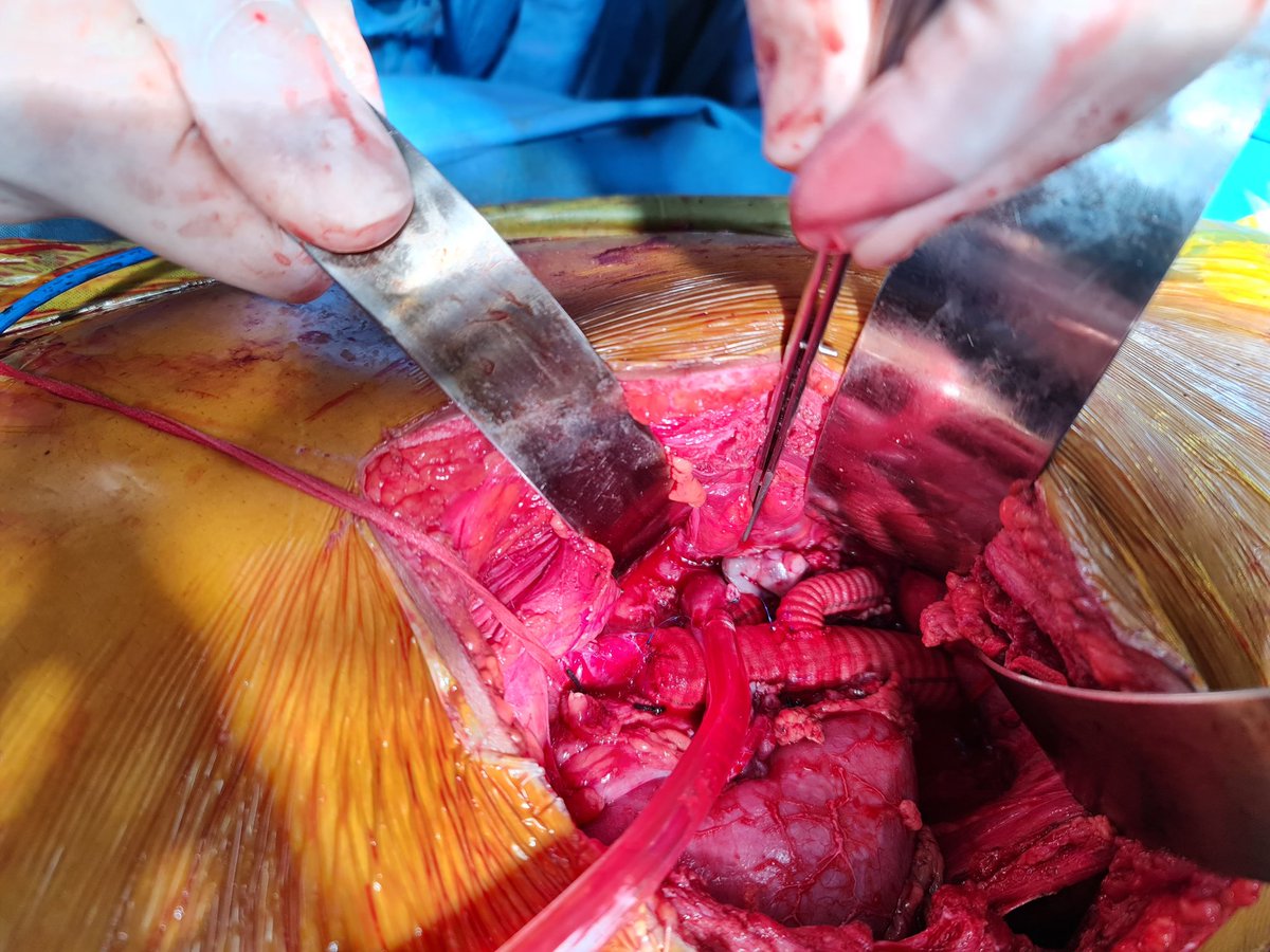Retroperitoneal no thoracotomy. Limb to celiac+sma+rt renal direct replant left renal. 21F. POD1 1000 ml urine planned extubation. Case proctored in EPIC hospital Ahmedabad #aorta #vascular #aneurysm #Fortis #aorticsurgery