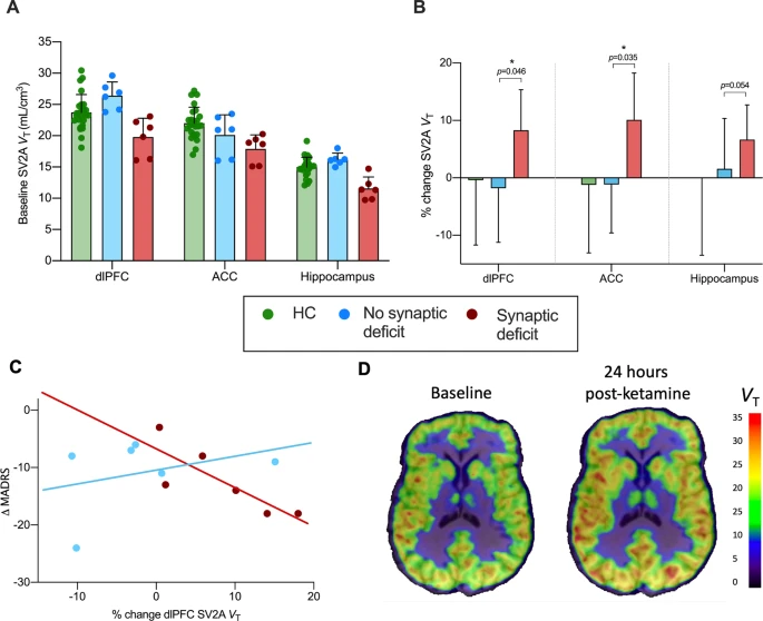 molpsychiatry's tweet photo. Imaging the effect of ketamine on synaptic density (SV2A) in the living brain. By Sophie E. Holmes et al. @YalePsych @sophie_eholmes #ketamine #psychiatry #synapticdensity #depression #mentalhealth https://t.co/e59jLtRJ59 https://t.co/9oO3mzHP5r