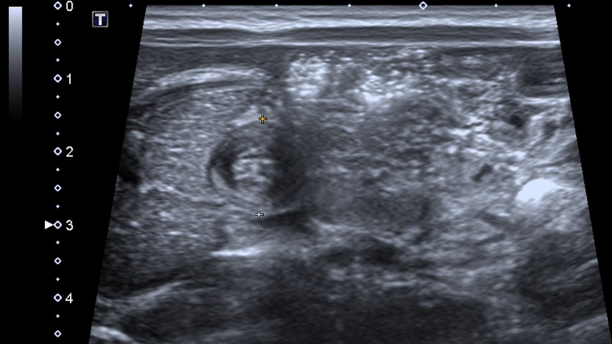 👶Neonato de 21 días de vida, con vómitos "en escopeta" y rechazo de la ingesta ❌🍼 a pesar de reducir y espaciar las tomas...

🎞️Imágenes de ecografía a la altura de epigastrio (eje largo y eje corto)

¿Qué te parece?

#BásicosDeRadiología ⚡️
#MIR2022 #MIR2023