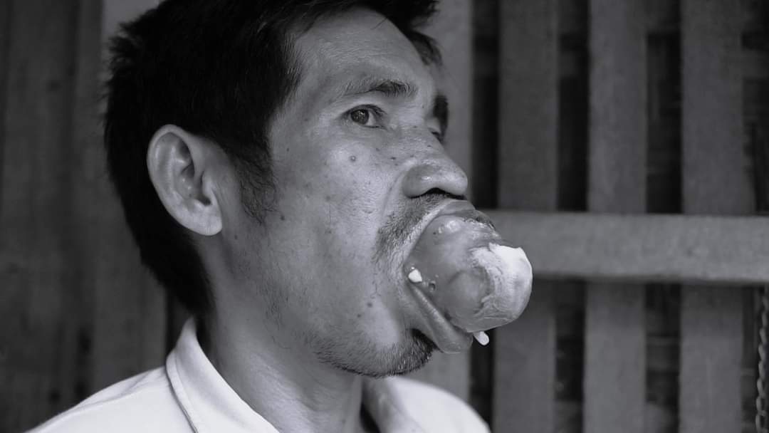 Please don't scroll without sharing 

We are raising funds for Tatay Efren's operation. The cliplock costs 100,000 and they still need 75,000 to continue with the surgery. Tatay Efren is diagnosed with Ameloblastoma and his family cannot sustain all the operation cost +