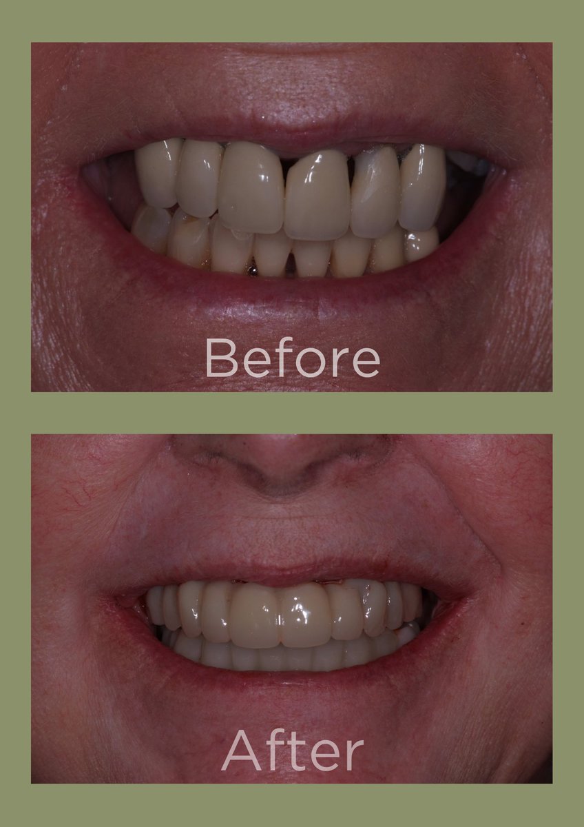 theimplantsage's tweet photo. Lynda was always told she couldn't have implants. That was before she met Dr Sanders.
She said- "I discovered that it wasn’t that I couldn’t have implants- it was simply that I hadn’t found the right dentist.”
Read Lynda's story here: 
https://t.co/4v214X7JI3 https://t.co/h1fDzeVsXC