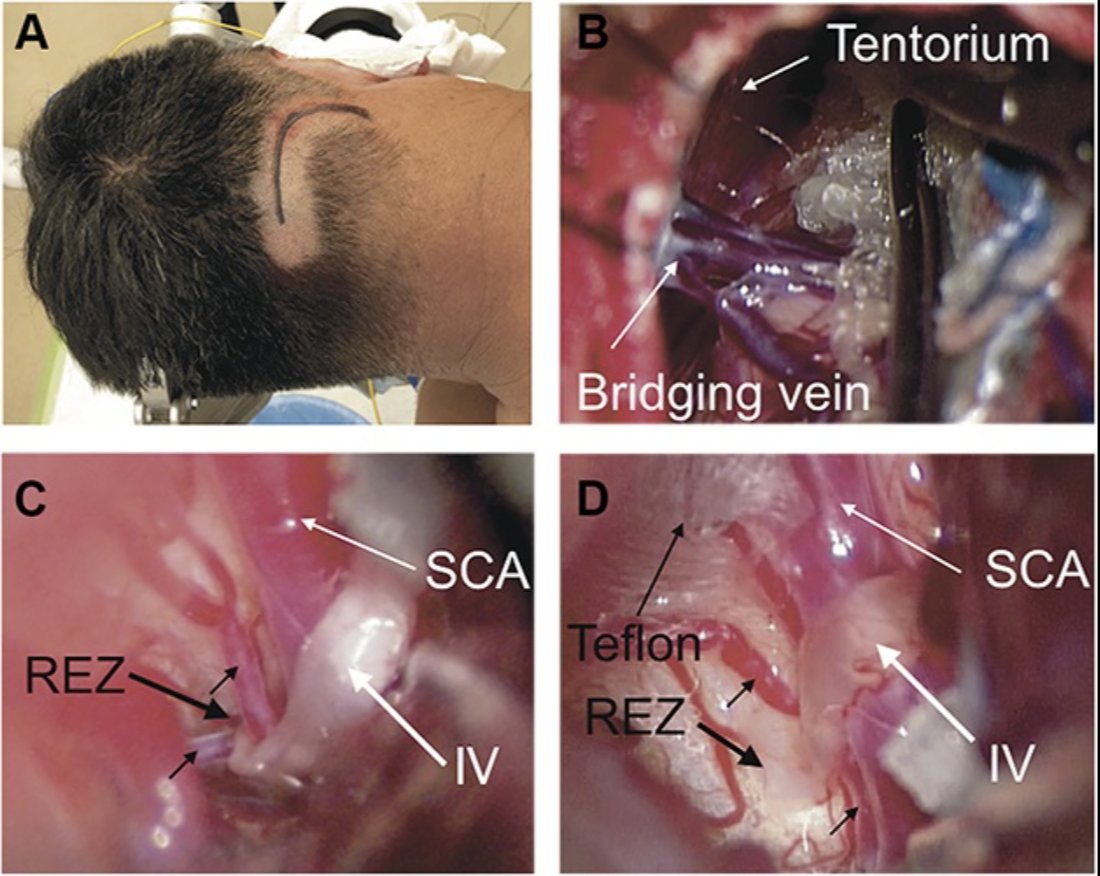 NeurosurgeryCNS's tweet photo. #ONSNew Lateral Supracerebellar Infratentorial Approach for Superior Oblique #Myokymia: A Case Series https://t.co/SEBZLls4so by Nora at Nakamura Memorial Hospital #Nsgy #Bridgingveins #Lateralsupracerebellarinfratentorialapproach #Microvasculardecompression https://t.co/a4e9UzVXFp