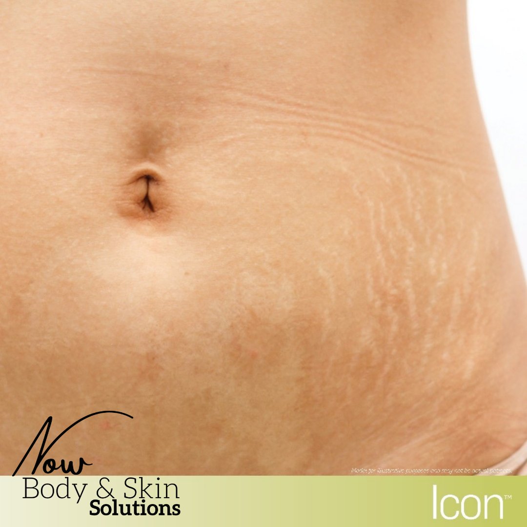 NOWBodyandSkin's tweet photo. In love with your new arrival, but dislike the impact that motherhood left on your body? Did you know that our Icon™ non-surgical stretch mark removal treatment can provide remarkable results in only a few short treatment sessions?  Schedule your stretch mark consultation today! https://t.co/C8qy0vxKz4