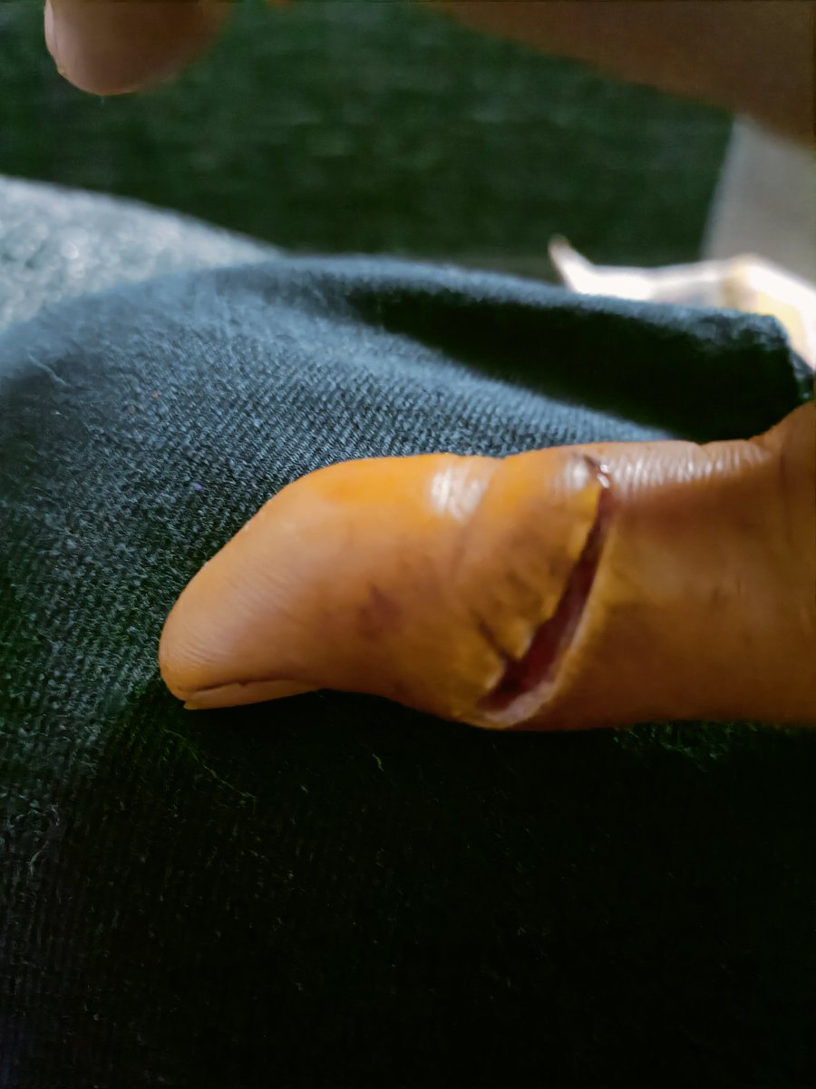 mintish0208's tweet photo. Valentine's day gave me a bloody day I mean real. I saw blood for the whole 24 hrs. The thumb resembled a sausage. Thankfully recovered #kitchenhazard #injuredfinger #accidentsinkitchen https://t.co/ouqelNaLCq