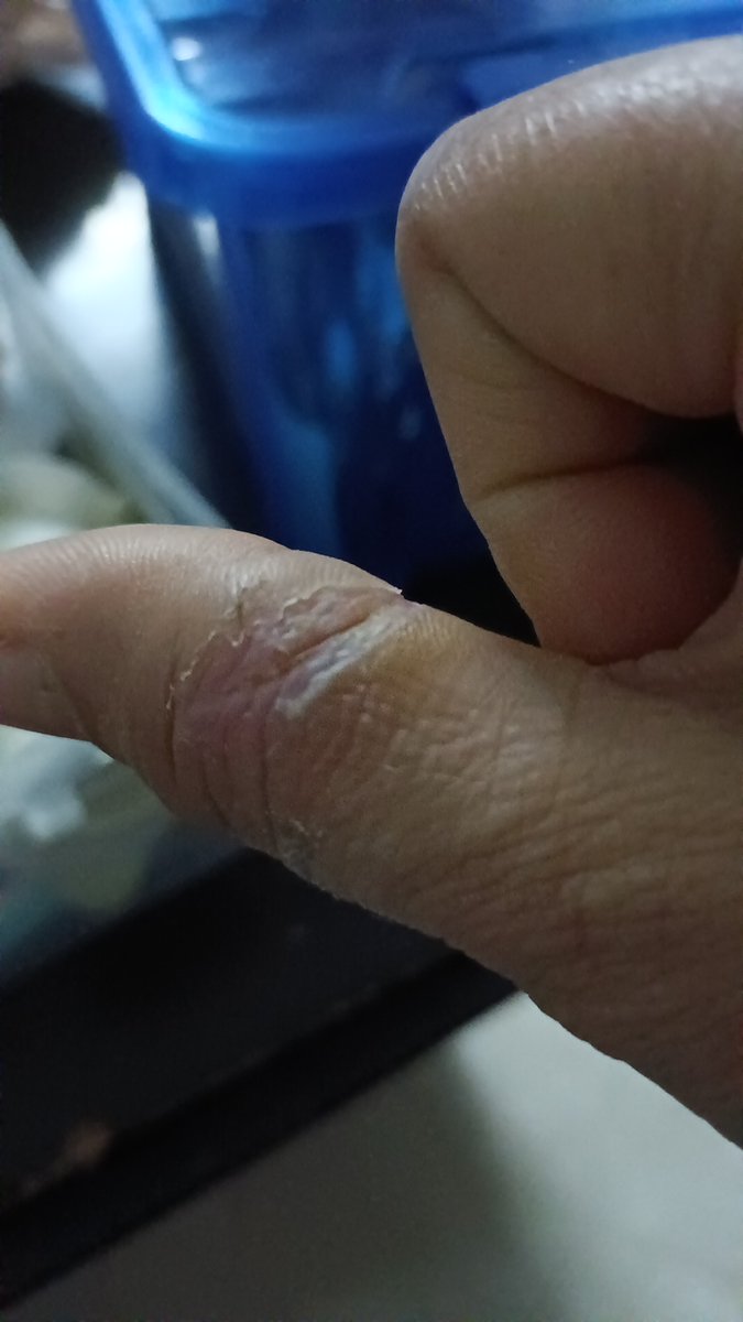 mintish0208's tweet photo. Valentine's day gave me a bloody day I mean real. I saw blood for the whole 24 hrs. The thumb resembled a sausage. Thankfully recovered #kitchenhazard #injuredfinger #accidentsinkitchen https://t.co/ouqelNaLCq