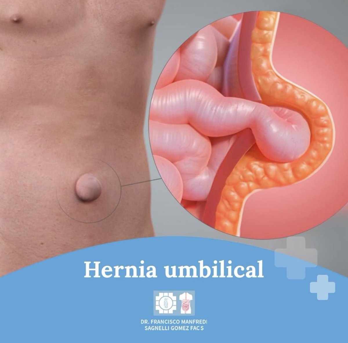 manfredi834's tweet photo. drfranciscomanfredi
hernia umbilical son:
Aparición de un bulto o protuberancia en la
zona umbilical.
Dolor, malestar e inflamación en la zona.
https://t.co/NNyyZvEw69
Para agendar una consulta
llama al +52 (33) 33439188 / 89 https://t.co/MfuxqjHjBV