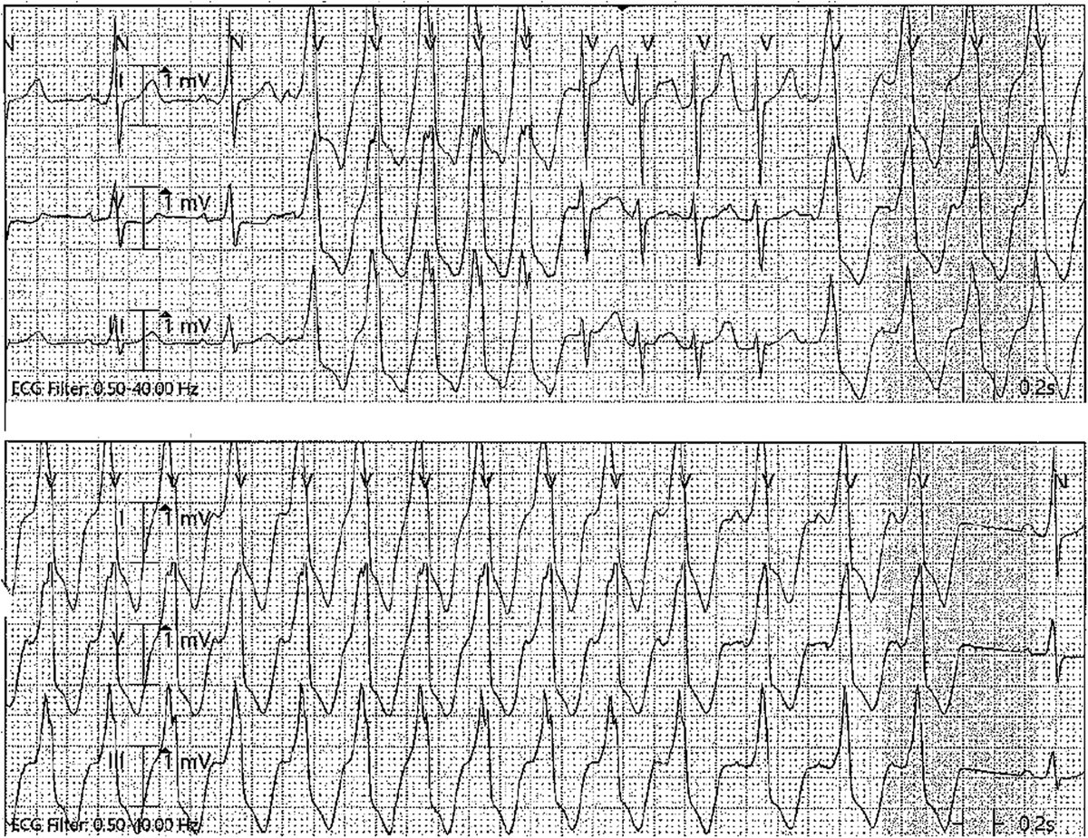 JACCJournals's tweet photo. #JACCCaseReports #WednesdayAnswer: AT w/ pre-excitation. Telemetry strips showed features that raise suspicion of AT: Tachycardia initiated w/ PAC, & PR interval & QRS complex configuration variability. Patient ultimately underwent #EPStudy & RF ablation. https://t.co/hquiN6rRHP https://t.co/YONiUzP4kT