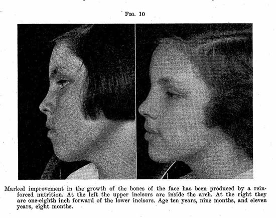 MacnabMalcolm's tweet photo. Never forget the impact of diet on facial health. 

Eat like a pleb and you will look like one. https://t.co/y0ReMdLyOg