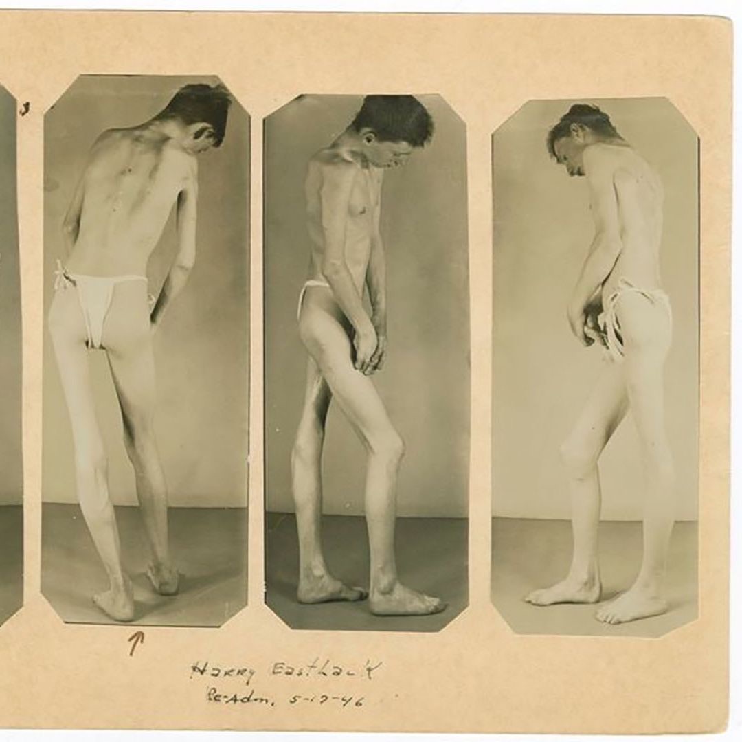 MutterMuseum's tweet photo. Today is #nationalrarediseaseday. Have you ever heard of #FOP? In the Museum, we have the skeletons of Harry Eastlack &amp; Carol Orzel. They lived with FOP, a disease that caused their bodies to grow bone where it does not usually grow. #raredisease #muttermuseum #medicalhistory https://t.co/OQ3nV3HYZY