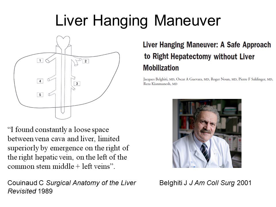 In 1989, #Couinaud described the loose precaval space between IVC and #liver. In 2001, #Belghiti described the #HangingManeuver now utilized in the anterior approach #hepatectomy. @oncsurg <a href="/IHPBA/">IHPBA</a> <a href="/SSATNews/">SSAT</a> <a href="/OscarGuevaraHPB/">Oscar Guevara</a> @PFSaldinger <a href="/acsJACS/">Journal of the American College of Surgeons (JACS)</a> <a href="/AHPBA/">AHPBA</a> <a href="/EAHPBA/">E-AHPBA</a> @mkatzmd <a href="/sgswisher/">Stephen Swisher</a>