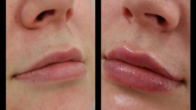 Absolutely beautiful results, soft dewy lips. <a href="/DrREdwards/">Richard Edwards</a> undetectable lip filler. Definition, shape and volume. Book a free consultation.