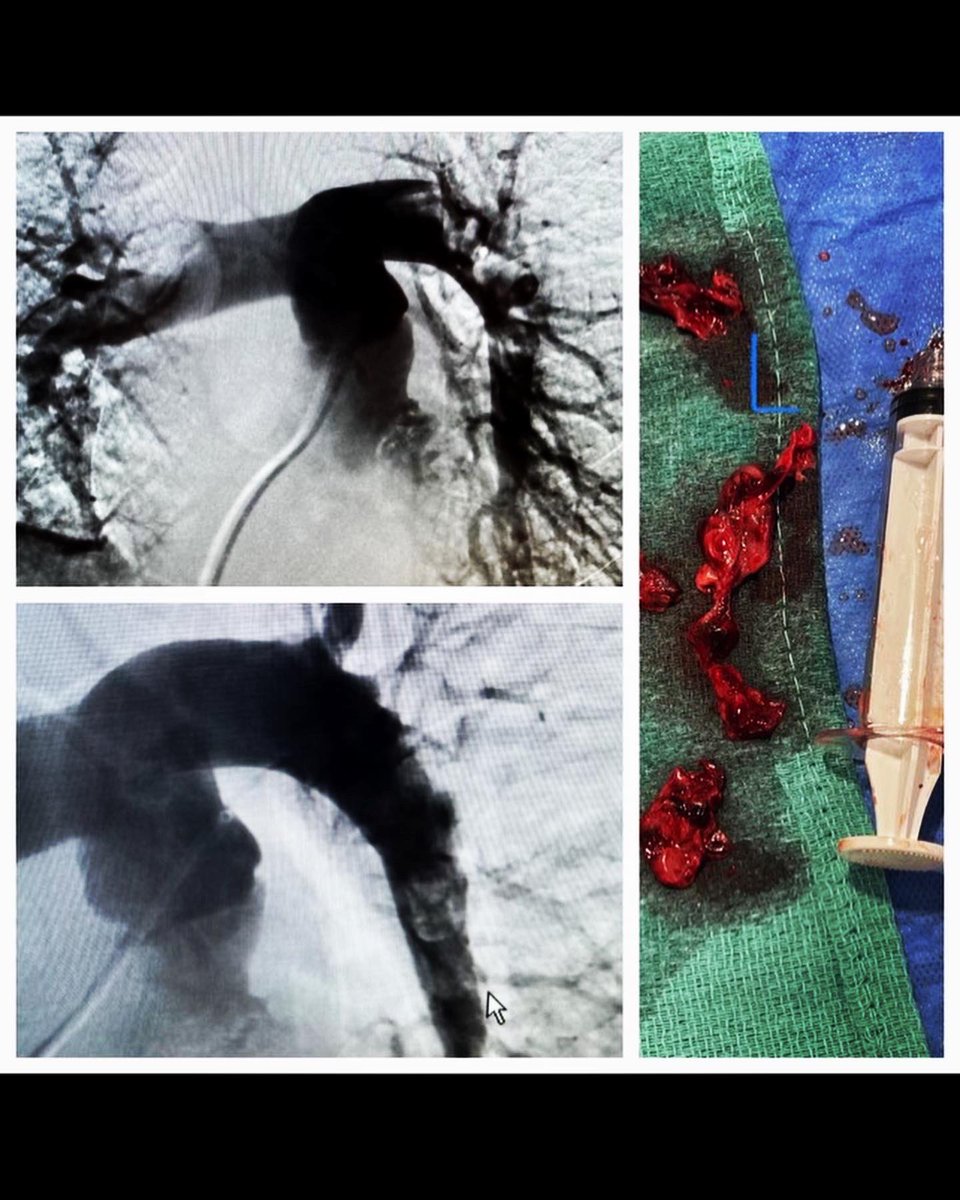 Houston Combined IR Residency (@hcirad) on Twitter photo Thrombecotmy in a patient with massive PE, appropriate corresponding decrease in PA pressure. <a href="/SIRspecialists/">Society of Interventional Radiology</a> <a href="/SIRRFS/">SIR RFS</a> <a href="/InariMedical/">Inari Medical</a> Thrombecotmy in a patient with massive PE, appropriate corresponding decrease in PA pressure. <a href="/SIRspecialists/">Society of Interventional Radiology</a> <a href="/SIRRFS/">SIR RFS</a> <a href="/InariMedical/">Inari Medical</a>