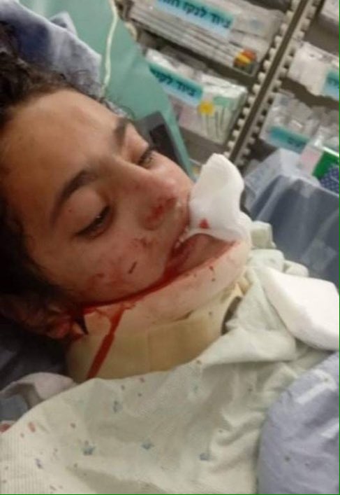 12yr-old Munawar Burqan, the deaf Palestinian girl who was savagely assaulted by israeli "police" has a broken jaw and requires surgery