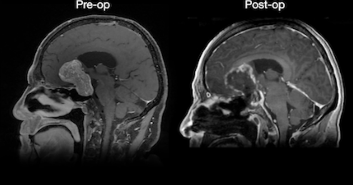 NeurosurgUCSF's tweet photo. Endoscopic removal of a giant pituitary adenoma by @UCSFHospitals neurosurgeon @ManishKAghi and otolaryngology - head &amp; neck surgeon Ivan El-Sayed, MD. https://t.co/mC6eXikK9L https://t.co/Y5hjLTHGHz