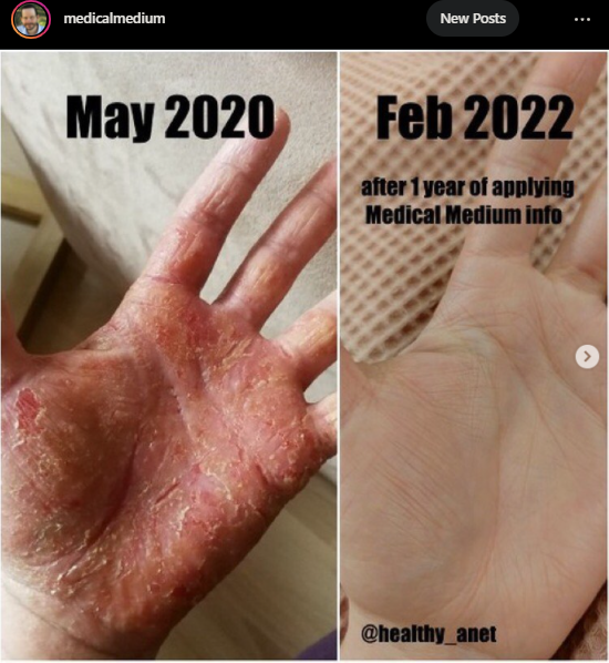 144Health's tweet photo. [TESTIMONY] Healing from #Eczema

"Although I found a lot of supportive doctors and naturopaths, nobody was able to help me effectively." 

[Full story below] #chronicillness #skinissue #skindisease #autoimmune #spoon #spoonie #skin #healing #miracle #medicalmedium #health https://t.co/woAahYI6HJ