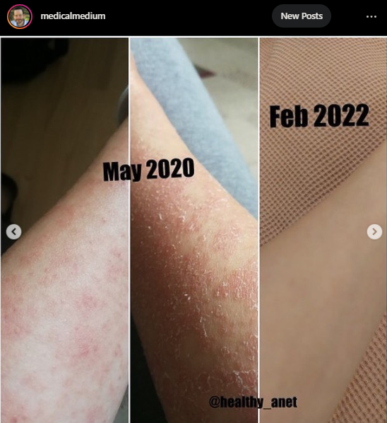 144Health's tweet photo. [TESTIMONY] Healing from #Eczema

"Although I found a lot of supportive doctors and naturopaths, nobody was able to help me effectively." 

[Full story below] #chronicillness #skinissue #skindisease #autoimmune #spoon #spoonie #skin #healing #miracle #medicalmedium #health https://t.co/woAahYI6HJ