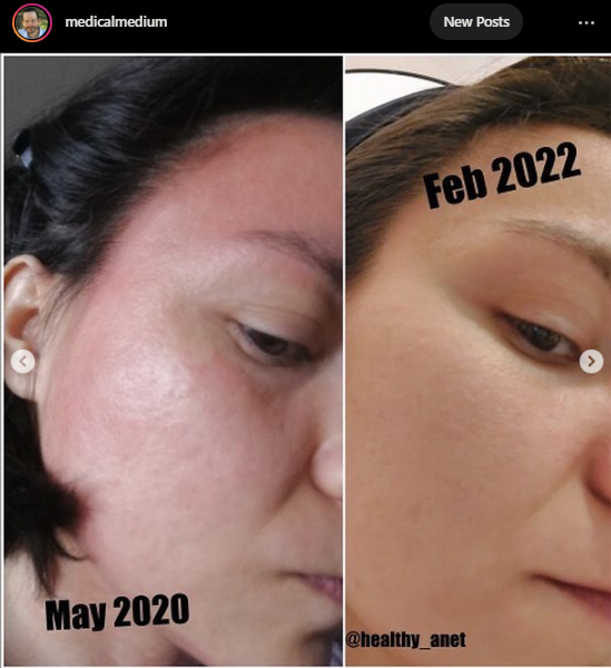 144Health's tweet photo. [TESTIMONY] Healing from #Eczema

"Although I found a lot of supportive doctors and naturopaths, nobody was able to help me effectively." 

[Full story below] #chronicillness #skinissue #skindisease #autoimmune #spoon #spoonie #skin #healing #miracle #medicalmedium #health https://t.co/woAahYI6HJ