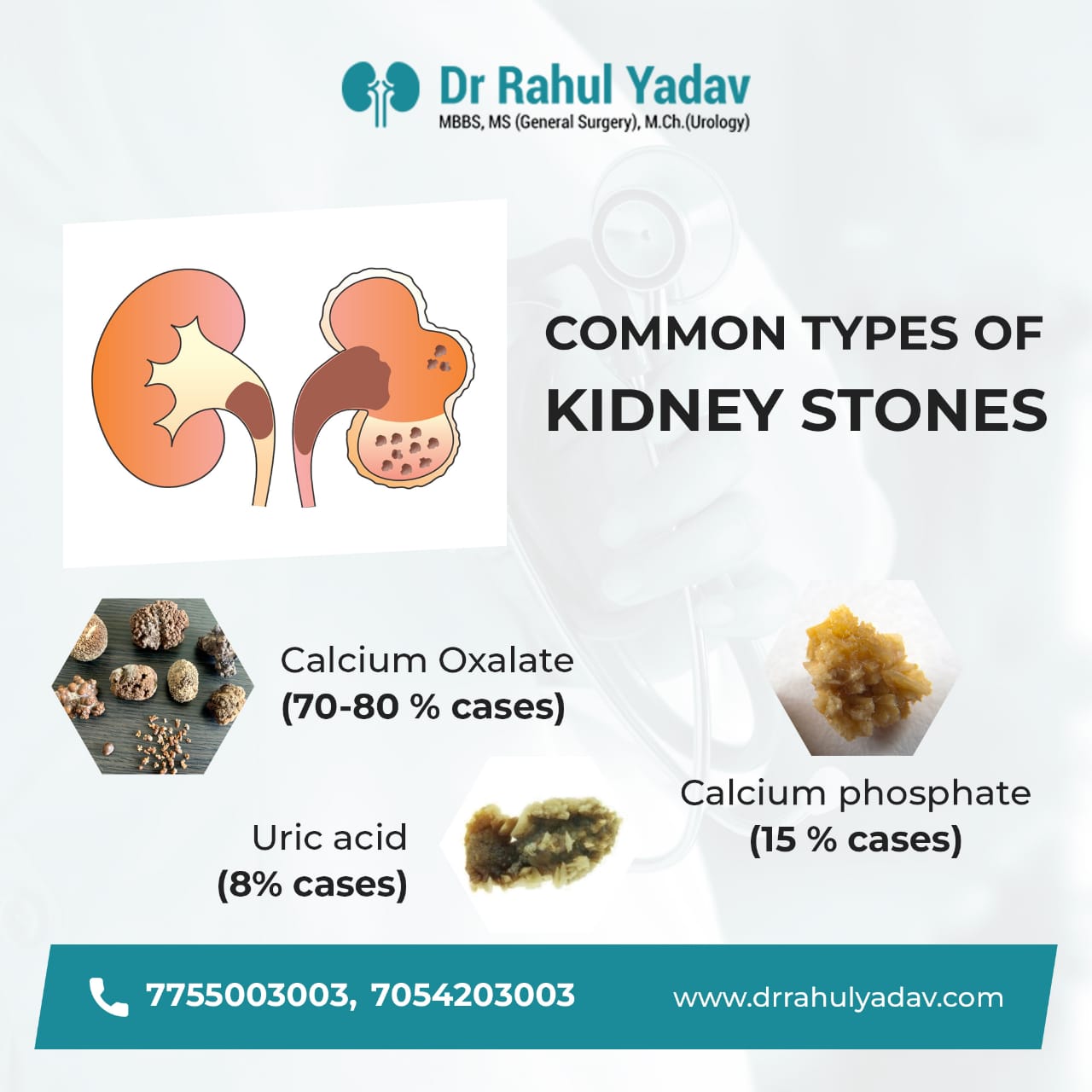 Calcium Phosphate Stone