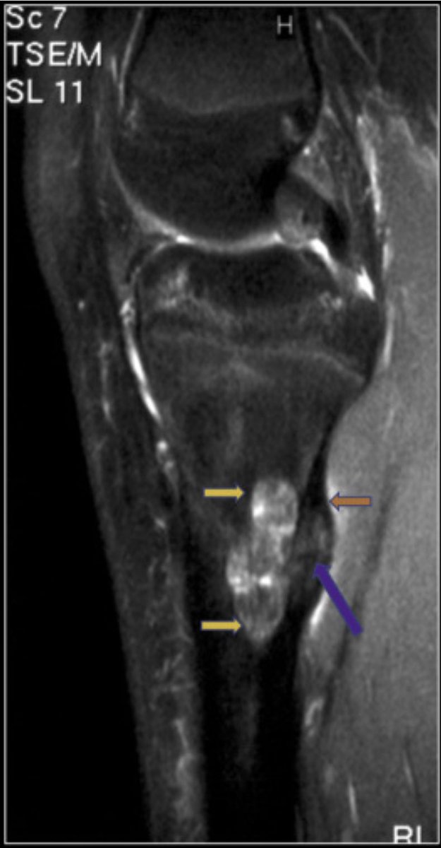 Excellent #MSKrad review on “Do-Not-Touch” bone lesions 👇👇👇
<a href="/mskradiology4u1/">mskradiology4u</a> <a href="/ROHKnowledgeHub/">ROH Knowledge Hub</a> <a href="/BSSR_Site/">BSSR</a> <a href="/ROHNHSFT/">The Royal Orthopaedic Hospital</a> @ELS_Radiology <a href="/_the_SRT/">The Society of Radiologists in Training</a> <a href="/RCRadiologists/">The Royal College of Radiologists</a> 

clinicalradiologyonline.net/article/S0009-…