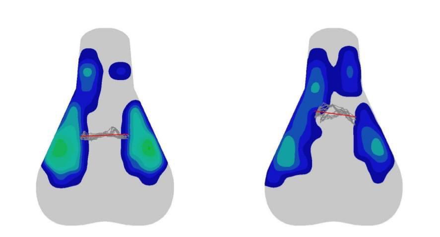 When you have historic data and a new saddle has come on the market, it's easy to cross reference whether or not this is a viable alternative.

Left image = old saddle
Right image = new saddle

Safe to say, the new saddle is a hit. 
#bikefit #bikefitting #physio #physiotherapy