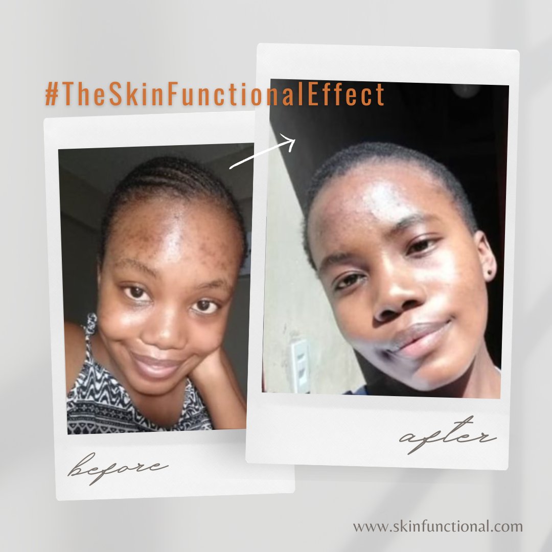 SkinFunctional's tweet photo. We love seeing your skin journey's & be a part of your transformation! π€©
Tag us in your journey with #TheSkinFunctionalEffect so we can share your story to help inspire those who might need it.π
#skinfunctional #skincarebusiness #skincarejourney #beforeandafter https://t.co/cL1Hdb0iIX