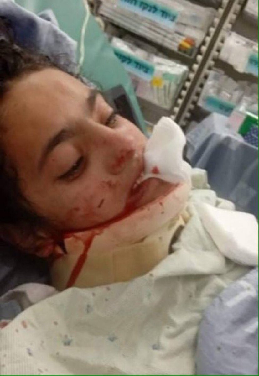 PalMediaOrg's tweet photo. Yesterday Israeli thugs masquerading as soldiers broke the jaw of 12 y/o deaf Palestinian girl Munawar Burqan in occupied East Jerusalem. https://t.co/eUFCTjqHbf