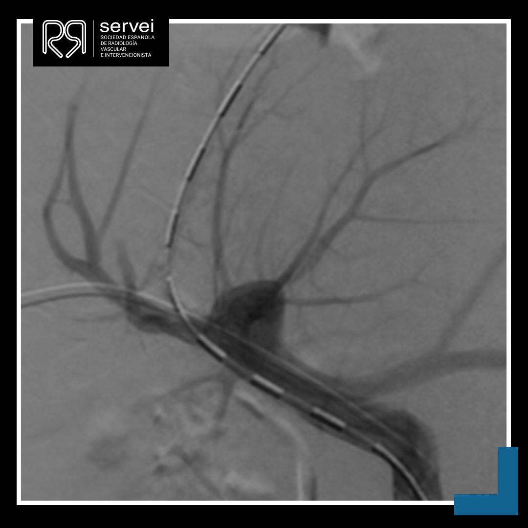 SERVEISoc's tweet photo. ¡Inauguramos marzo🌻 con nuestro CASO CLÍNICO del mes!
🔸 TIPS en Síndrome Budd-Chiari
Complejo caso que nos presentan nuestros compañeros de #RadiologíaIntervencionista del @HospitalLaFe de Valencia!
⬇️ ⬇️ ⬇️
https://t.co/EuovFLsvmI
#casoclínico #FOAMIR #Radiología https://t.co/AGJfApO8m1