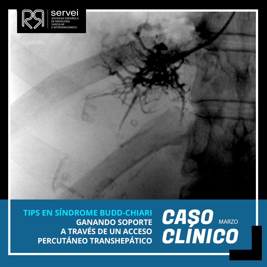 SERVEISoc's tweet photo. ¡Inauguramos marzo🌻 con nuestro CASO CLÍNICO del mes!
🔸 TIPS en Síndrome Budd-Chiari
Complejo caso que nos presentan nuestros compañeros de #RadiologíaIntervencionista del @HospitalLaFe de Valencia!
⬇️ ⬇️ ⬇️
https://t.co/EuovFLsvmI
#casoclínico #FOAMIR #Radiología https://t.co/AGJfApO8m1