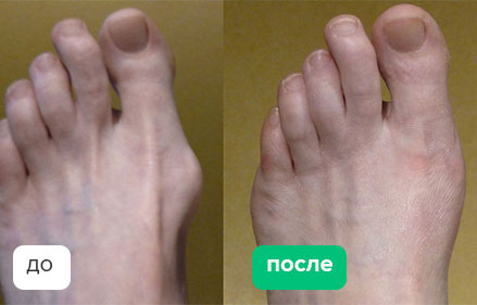 Полидактилия холли берри. Плоскостопие косточки на ноге. Foot measurements. Подошвенный фасцит стопы. Вальгусный корректор вальгус стоп.