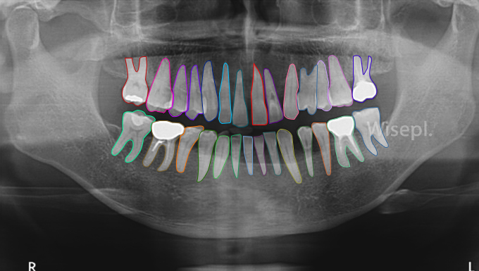 Wisepl_'s tweet image. Image Annotation for Dental dataset

Wisepl helps to annotate 3D dental x-ray, panoramic images for computer vision and machine learning product developments.

#dentalannotation #medicalai #polygonannotation #computervision #3Ddentalxray #teethannotation #wisepl #machinelearning