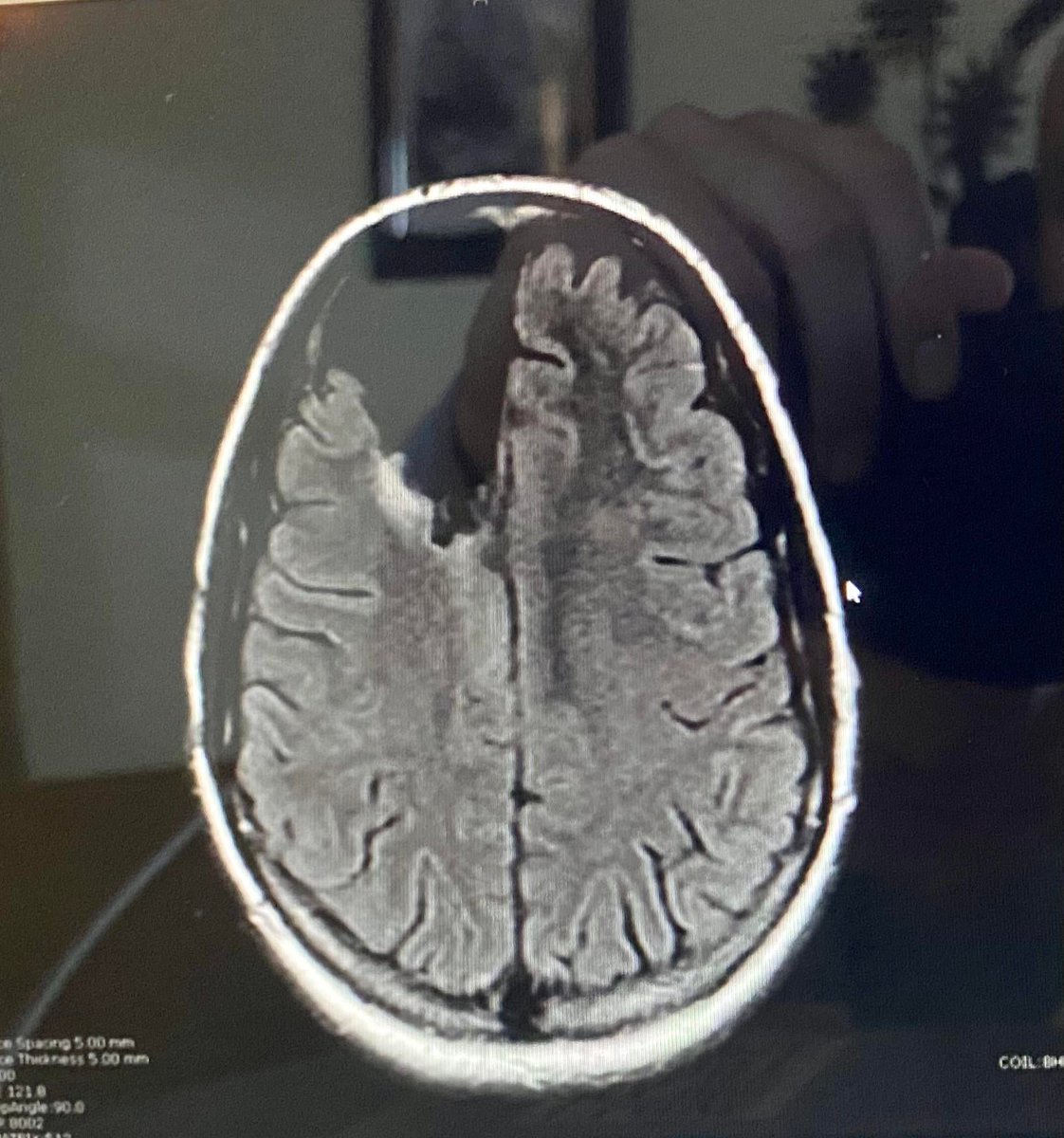 A brain scan from a typical WSB ape. Frontal lobe missing via /r/wallstreetbets #stocks #wallstreetbets #investing

https://t.co/gpMKimeh9q

#investment #investing https://t.co/5W505UEZqB