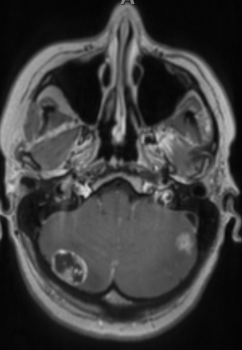It’s the start of #BrainTumourAwarenessMonth and this is one slice of what’s going on in my head at the moment. I’ve got 9 of the little white guys, and 1 of the big fella at the back #unwelcomevisitors we’re raising funds for more research. Visit wellerfest.com