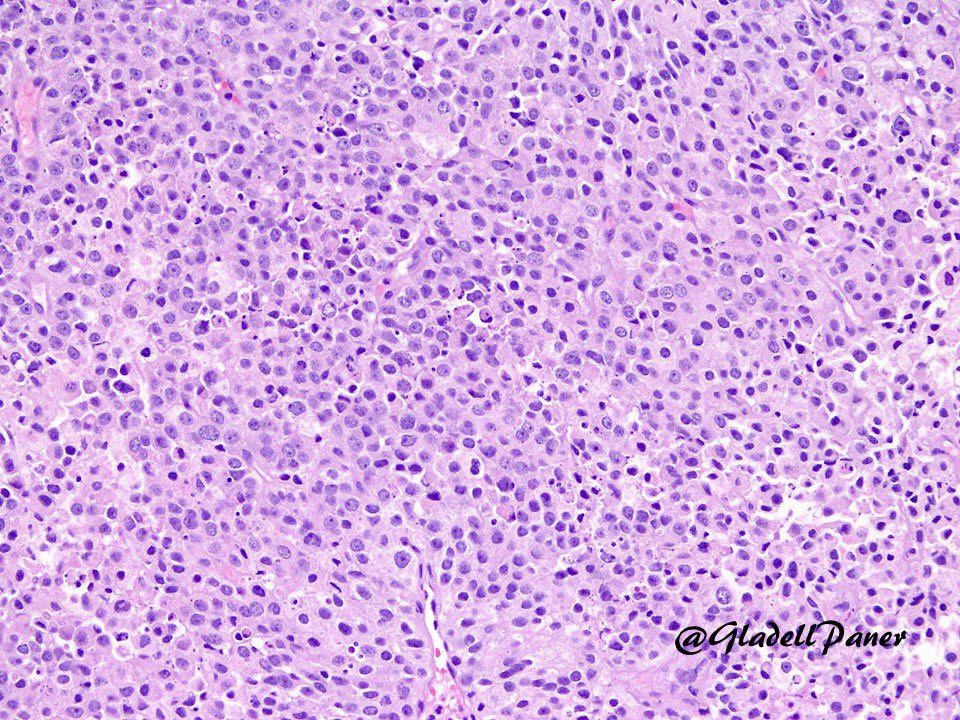 GladellPaner's tweet image. Wall-to-wall carcinoma cells. #Bladder or #prostate carcinoma? #SubtleHint #GUPath