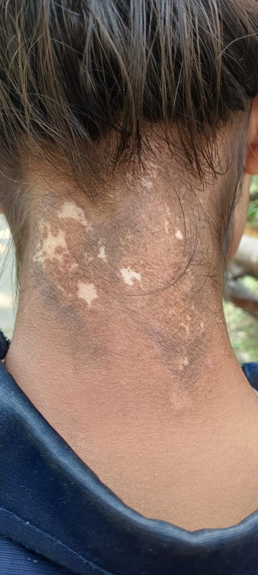 Swapnil70099615's tweet photo. If u believe in Ayurveda ... 
Ayurveda will give u everything.. 
Successful case of switra ( leucoderma ).
Just given some medicine with diet . 
@Bams_doctors 
@bams_india https://t.co/yz7SGmZg0r