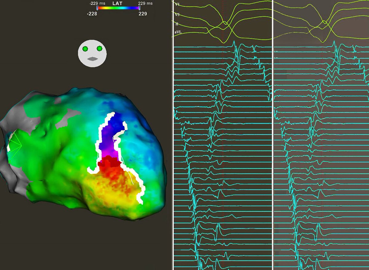 MBergonti's tweet image. It was a nice channel, but we had to burn it 🔥

#VT #HDmapping with #Octaray.  @AndreaSarkozy, @Salavtore4 

ILAMs, Substrate and ECG in the comments
 
#EPeeps #CardioTwitter @EPeeps_Bot @BiosenseWebster