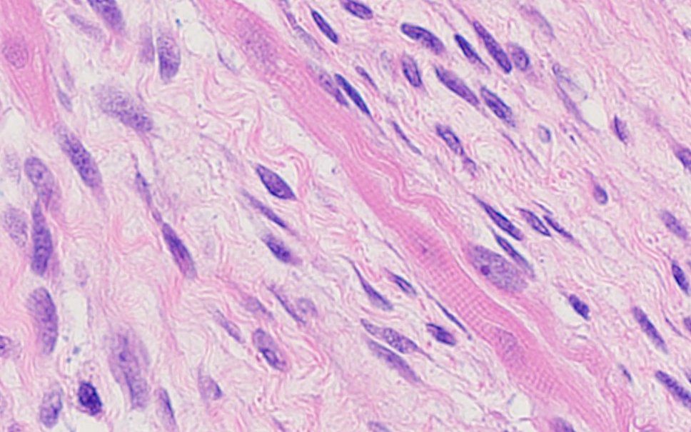 MArnold_PedPath's tweet photo. Here's some #PediPath fun: What's your diagnosis for this tumor? Or am I hiding something... https://t.co/fR62ieixTl