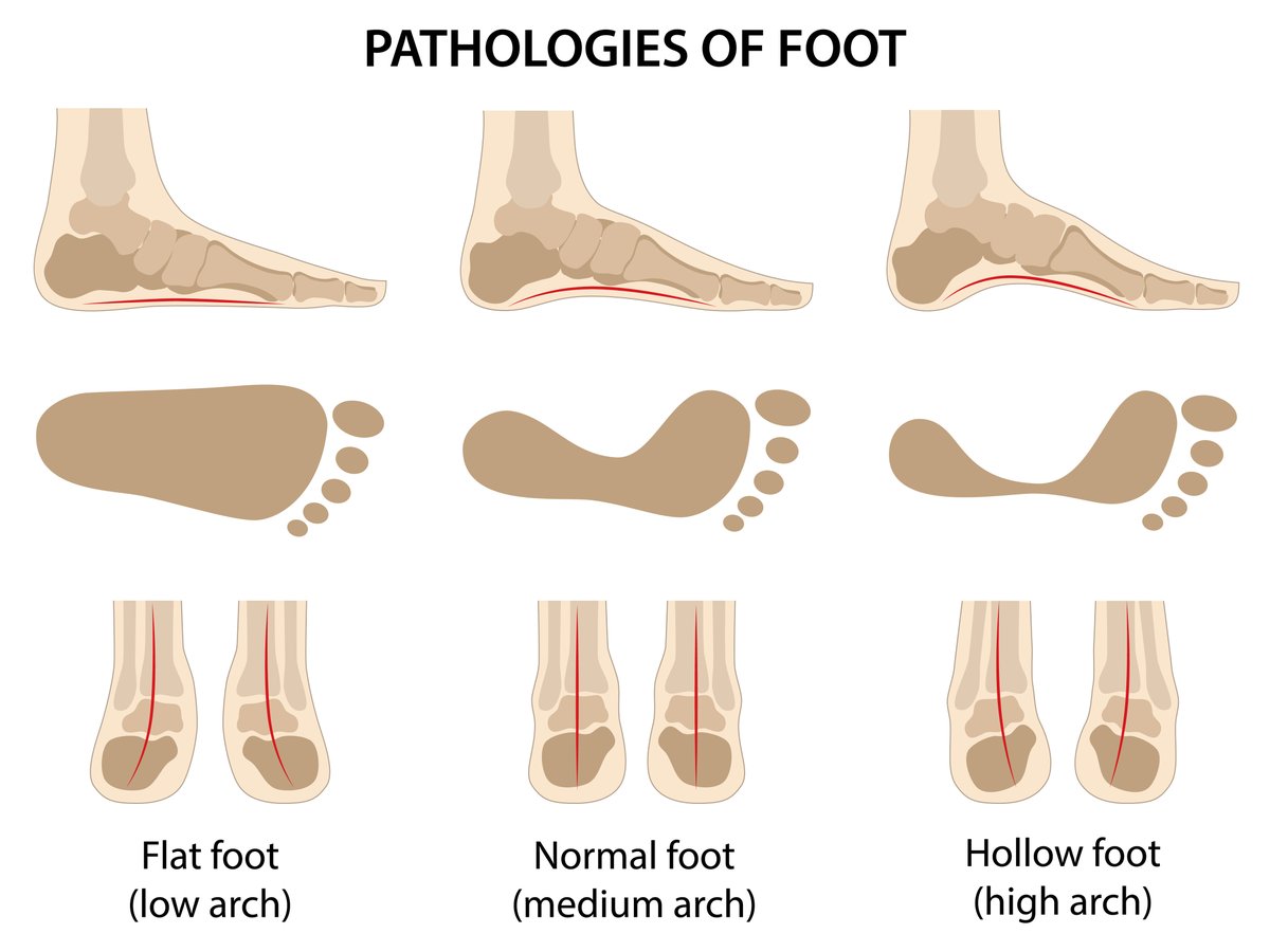 What are the different types of foot arches? Find out by reading through our FAQ page! idahofoot.com/faq.cfm